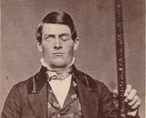 Phineas Gage: The Man Who Survived the Impossible