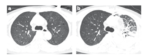 First Pig-to-Human Lung Transplant